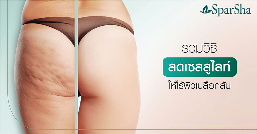 Leg Squeezing ลดเซลลูไลท์ ปัญหาผิวเปลือกส้ม