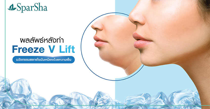Freeze V Lift สลายไขมันเหนียงด้วยความเย็น