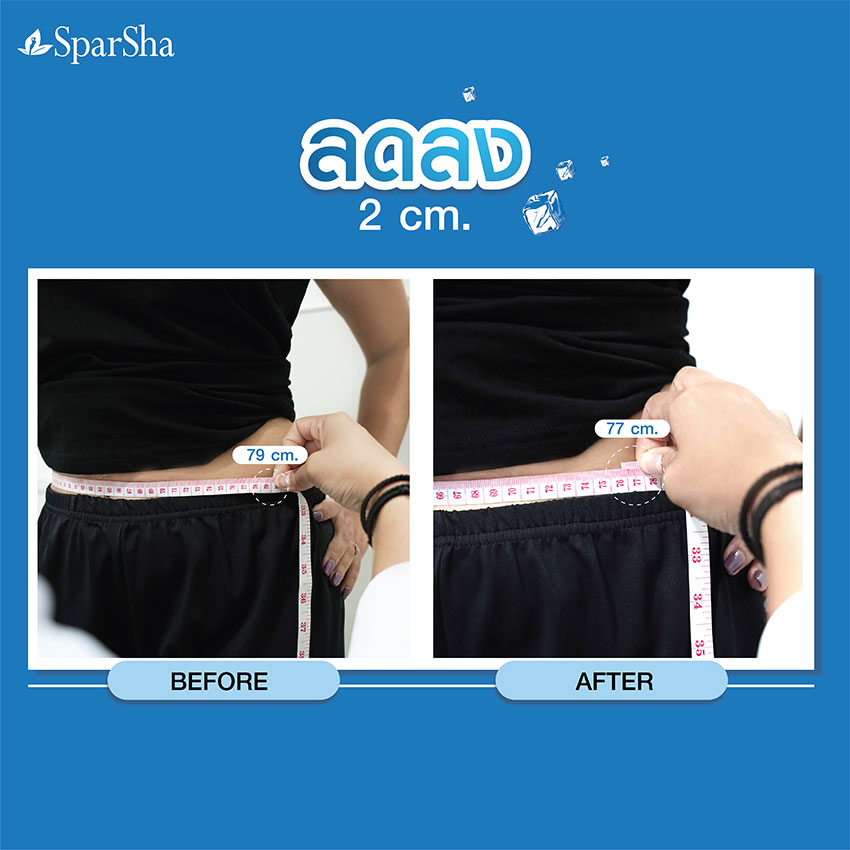 สลายไขมัน Freeze Shaping (คุณศจี วงศ์อำไพ)