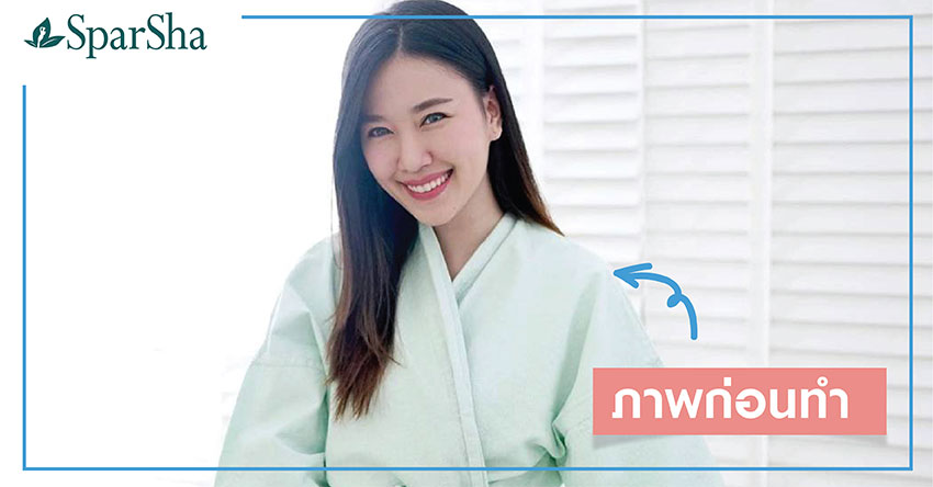 Freeze Shaping สลายไขมันด้วยความเย็น