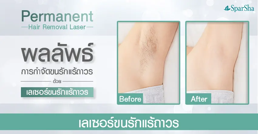 10 เหตุผลควรเลเซอร์กำจัดขนรักแร้ใต้วงแขนถาวร