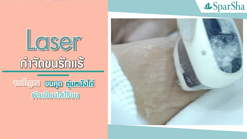 Permanent Hair Removal Laser กำจัดขนถาวร