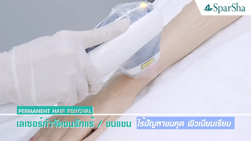 Permanent Hair Removal Laser กำจัดขนถาวร