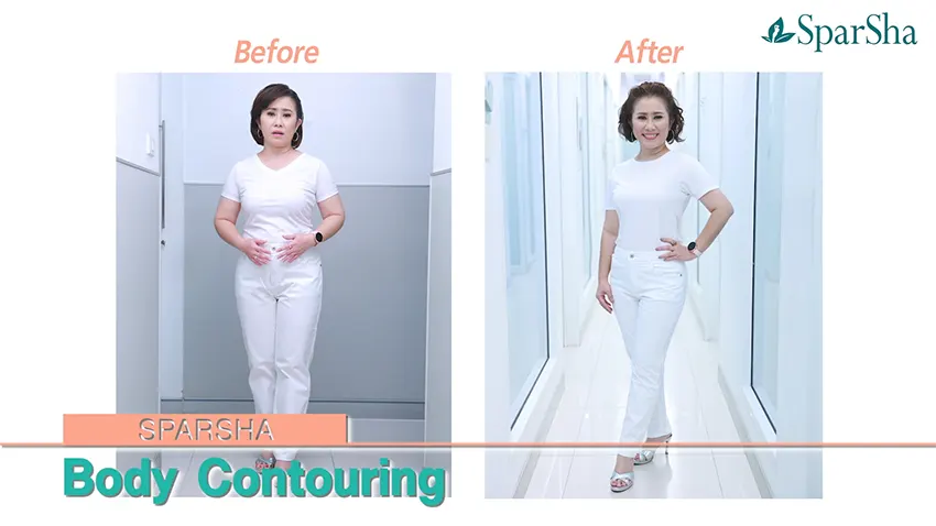 Body Contouring โปรแกรมลดสัดส่วนทั้งตัวอย่างเร่งด่วน