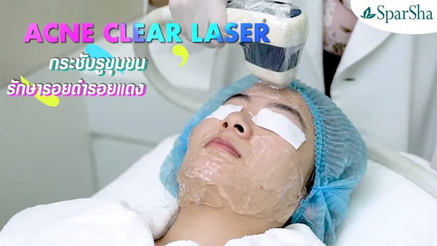 ฆ่าเชื้อสิว Acne Clear Laser ปัญหาสิว เลเซอร์รักษาสิว