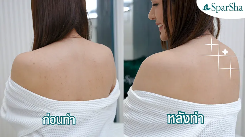 Acne Body Mist ลดรอยสิว ลดจุดด่างดำ ลดรอยดำ