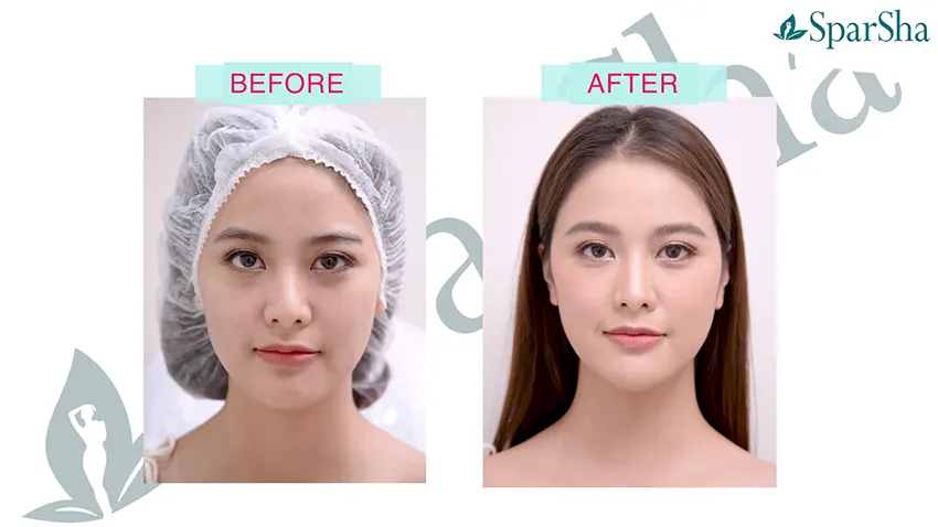 Viva Lift ยกกระชับหน้า