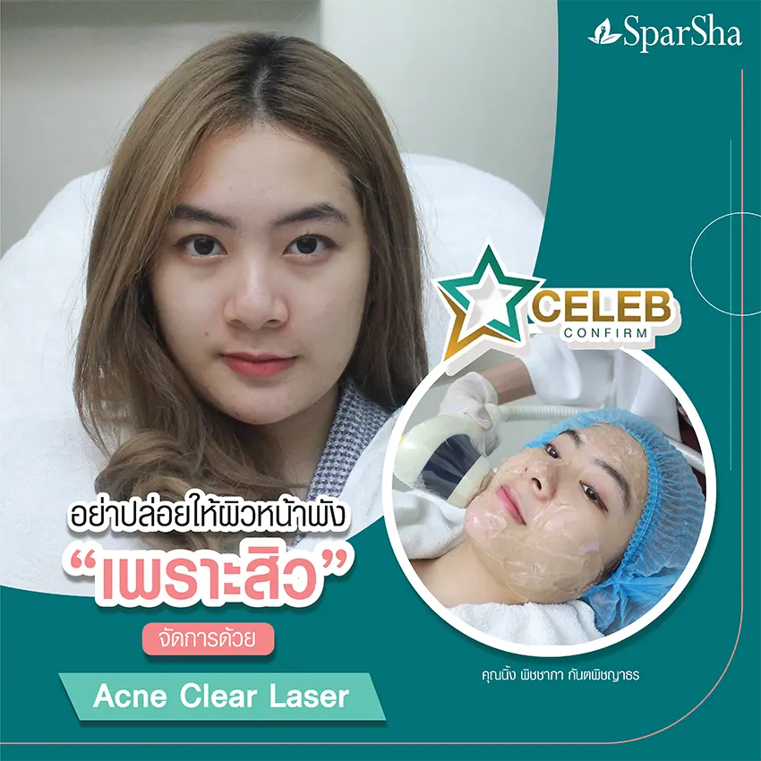 Acne Clear Laser คุณนิ้ง พิชชาภา กันตพิชญาธร