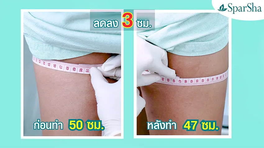 Leg Squeezing ลดเซลลูไลท์ ปัญหาผิวเปลือกส้ม