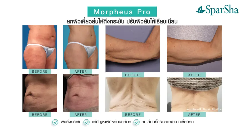 Morpheus Pro ยกกระชับ