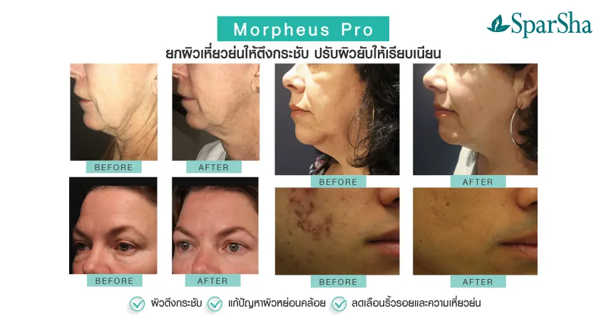 Morpheus Pro ยกกระชับ