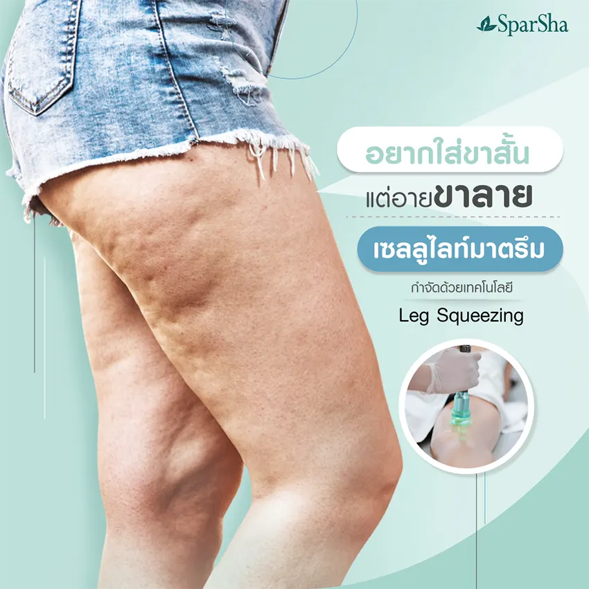Leg Squeezing ลดเซลลูไลท์ ปัญหาผิวเปลือกส้ม