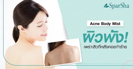 Acne Body Mist ผิวพังเพราะสิวที่หลังทำร้าย