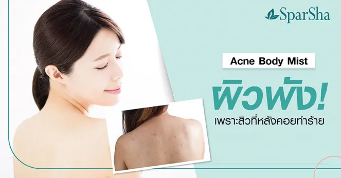 Acne Body Mist ผิวพังเพราะสิวที่หลังทำร้าย