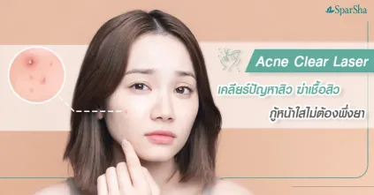 Acne Clear เลเซอร์รักษาสิวแก้ปัญหาสิวฆ่าเชื้อสิว