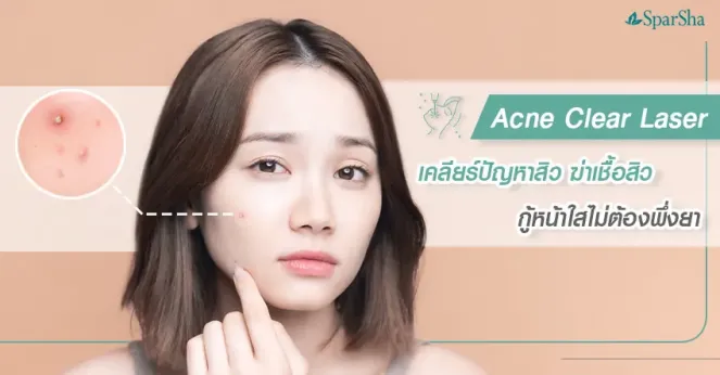 Acne Clear เลเซอร์รักษาสิวแก้ปัญหาสิวฆ่าเชื้อสิว