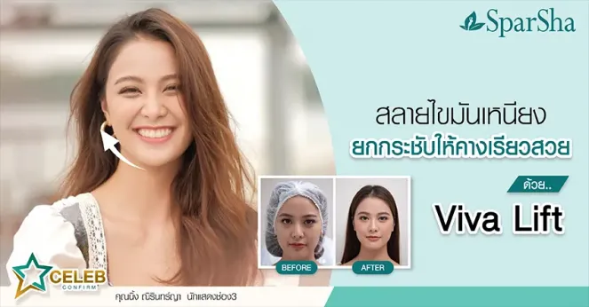 สลายไขมันเหนียงยกกระชับให้คางเรียวสวยด้วย Viva Lift (คุณนิ้ง ณิรินทร์ญา นักแสดงช่อง 3)